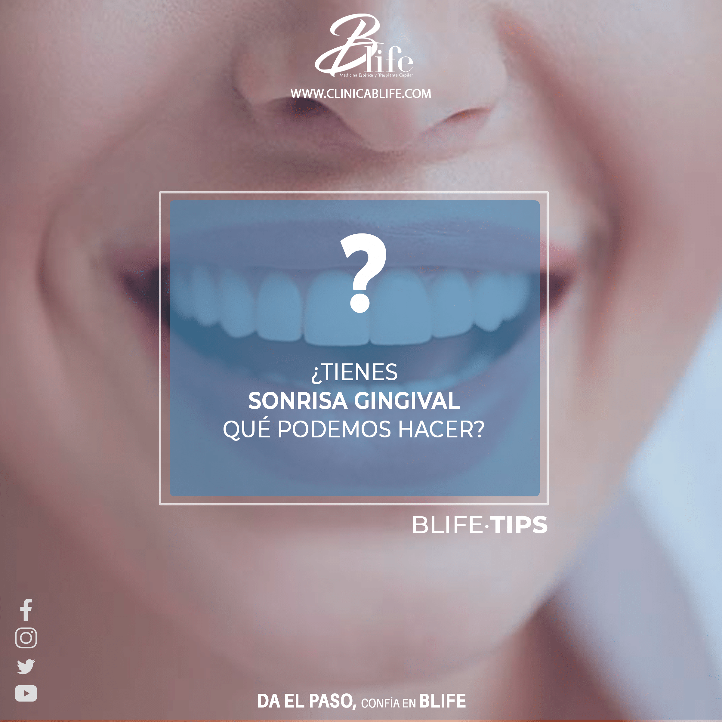 TRATAMIENTO-SONRISA-GINGIVAL