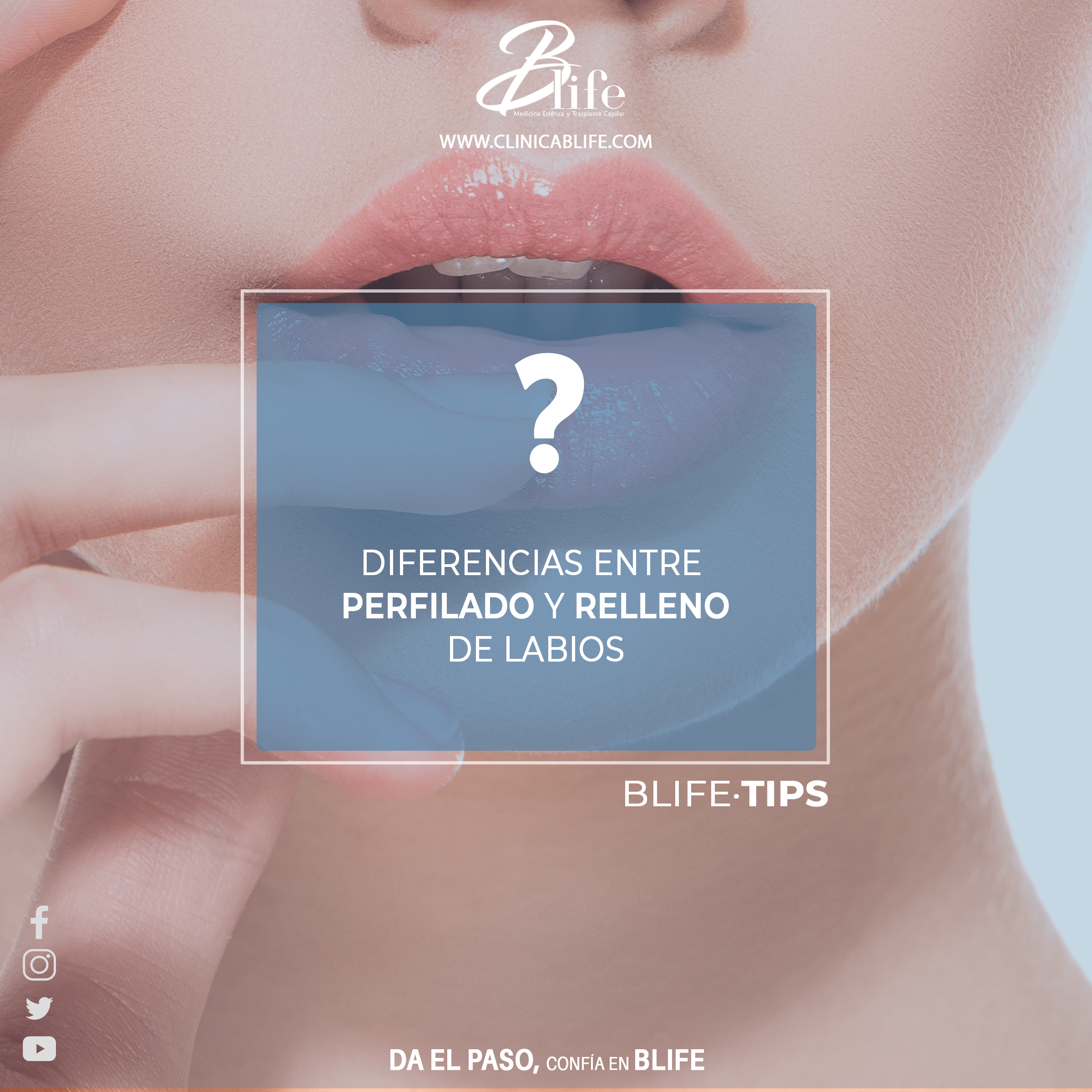 relleno o perfilado de labios con ácido hialurónico