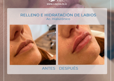Relleno-de-labios-madrid-antes-y-despues-