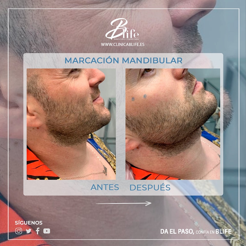 Masculinización Facial Madrid
