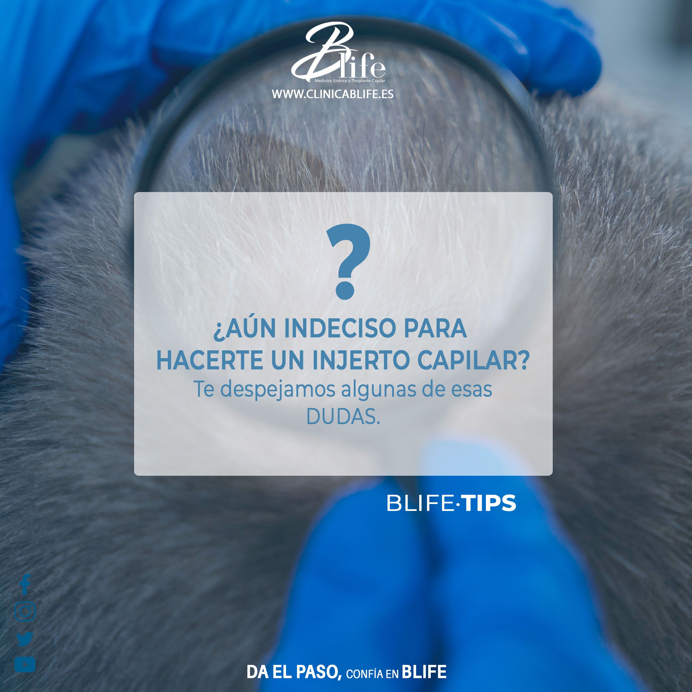 ¿Aún con dudas sobre dónde hacerte el Trasplante Capilar o cuál es el mejor método para el Injerto Capilar?