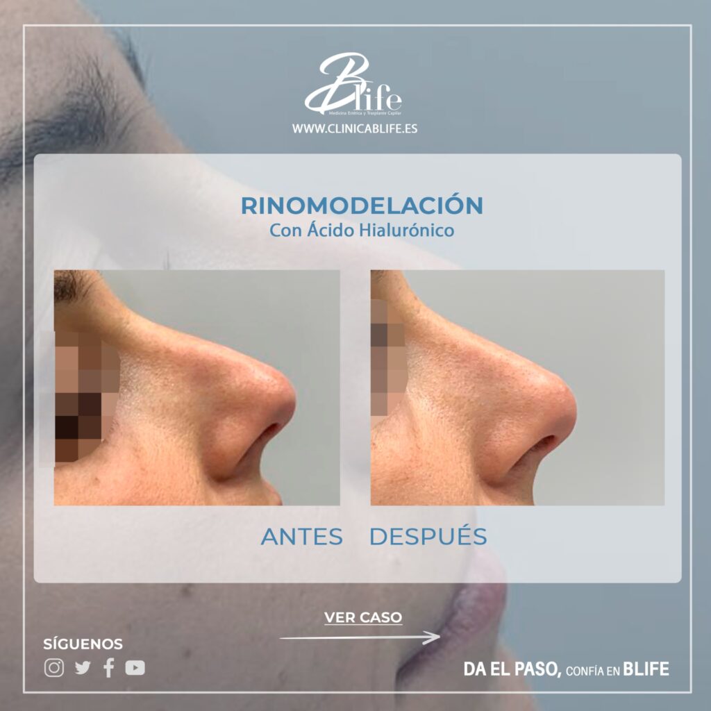 ANTES Y DESPUES RINOMODELACION