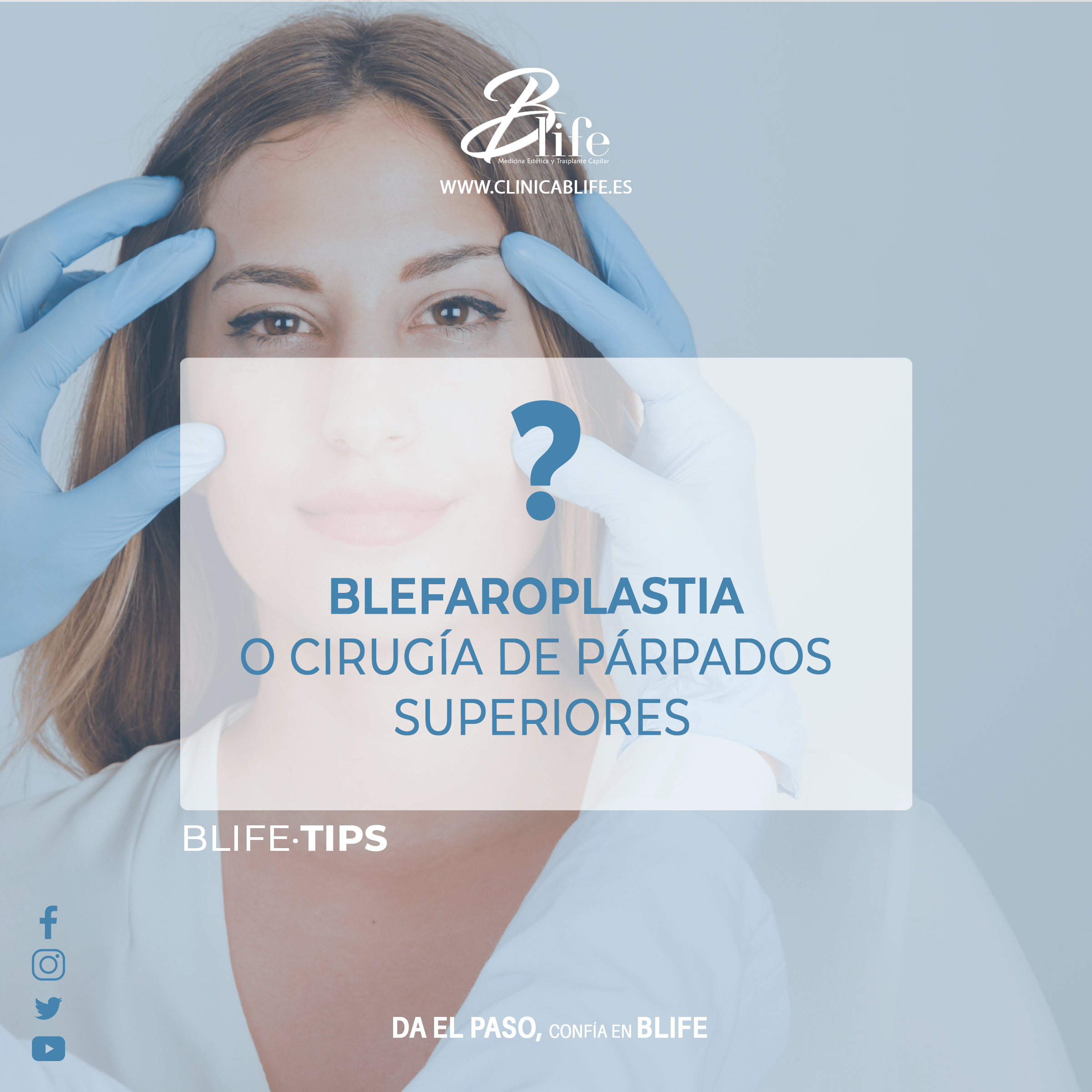 blefaroplastia o parpados caidos en madrid