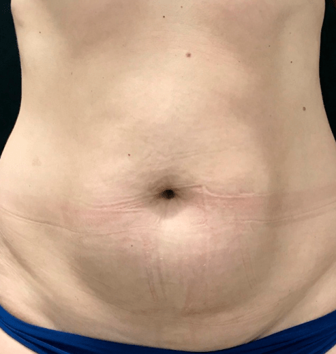 BODY FX - Blife Estética y Capilar