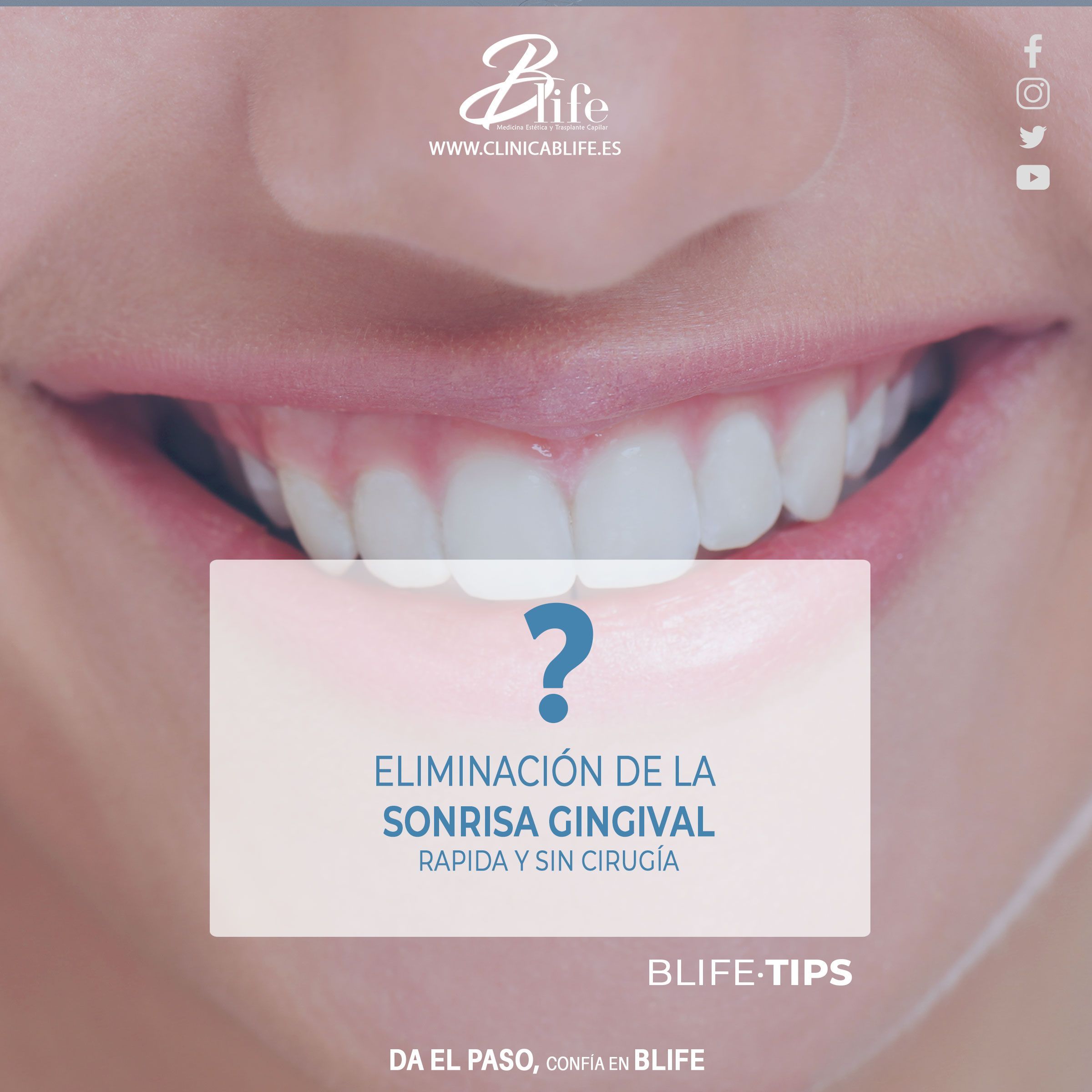 ELIMINACION-DE-LA-SONRISA-GINGIVAL