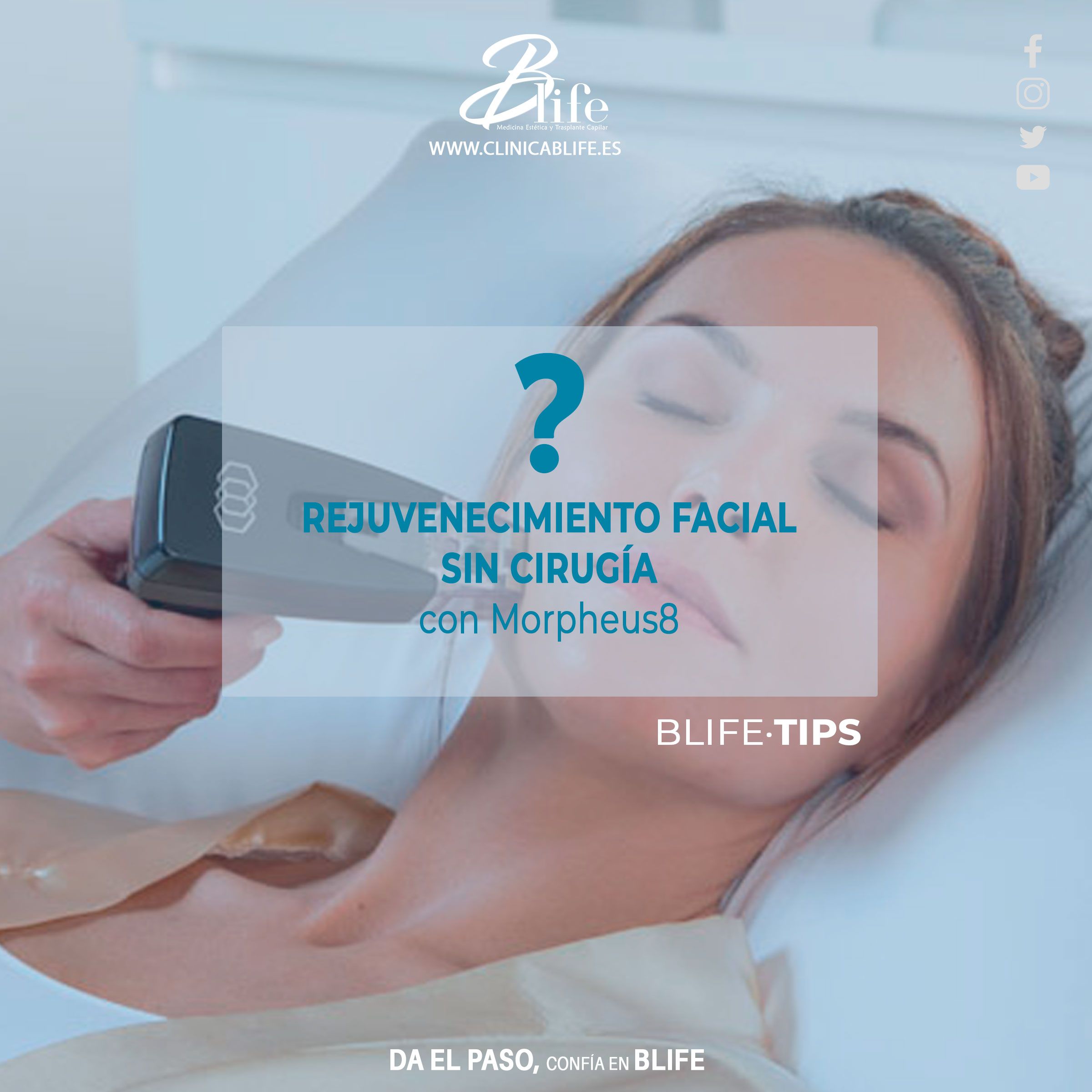 Tratamiento de radiofrecuencia facial en Madrid: Morpheus8