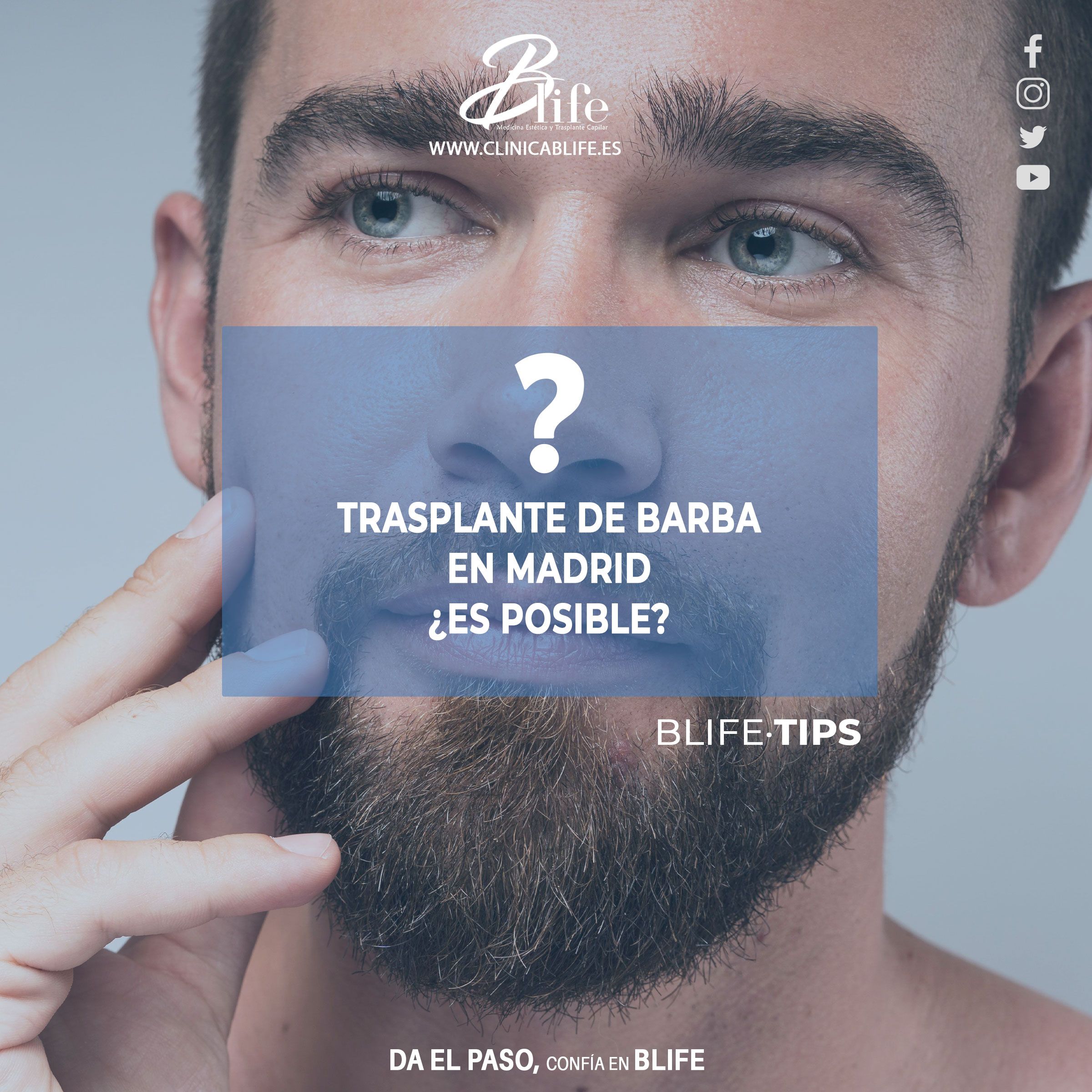 Trasplante de Barba en Madrid