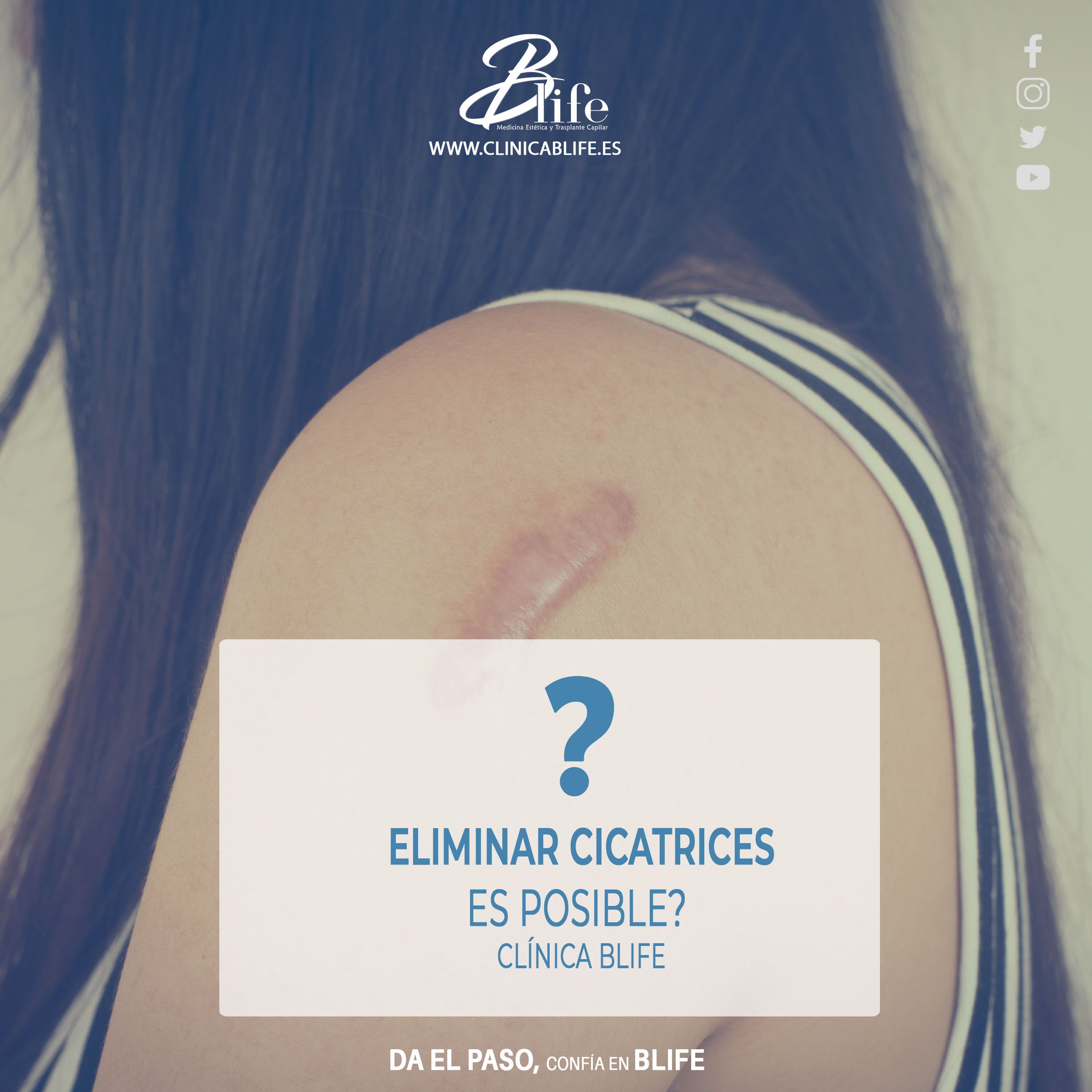 Eliminar cicatrices en Madrid: Recupera la uniformidad de tu piel con tecnología médica