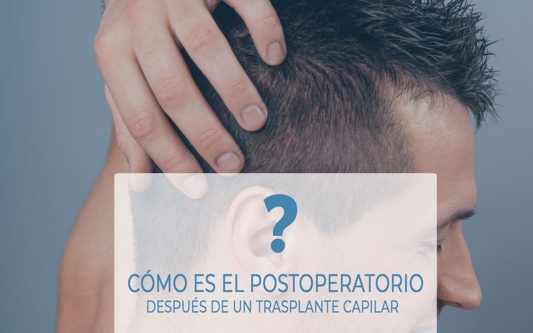 Postoperatorio de un injerto capilar en Madrid: Guía para una recuperación perfecta