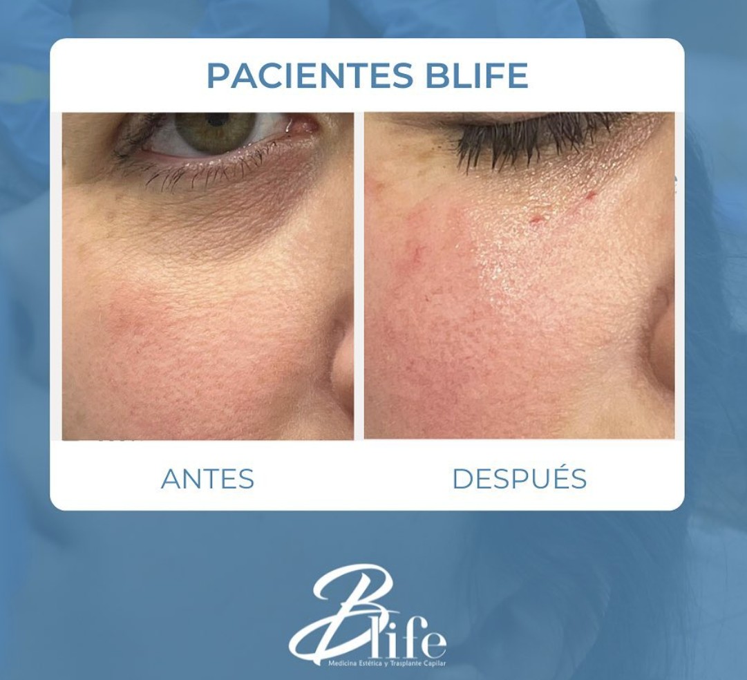 ANTES Y DESPUES TRATAMIENTO ANTIOJERAS