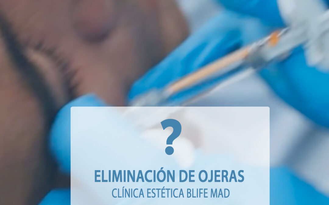 Eliminar ojeras en Madrid: todo lo que debes saber sobre el tratamiento con ácido hialurónico