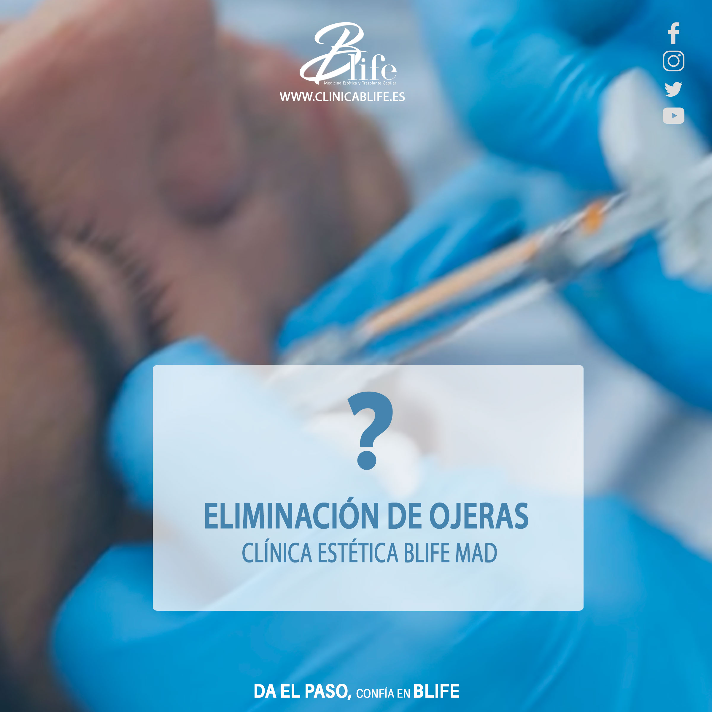 ELIMINACION-DE-OJERAS-EN-MADRID