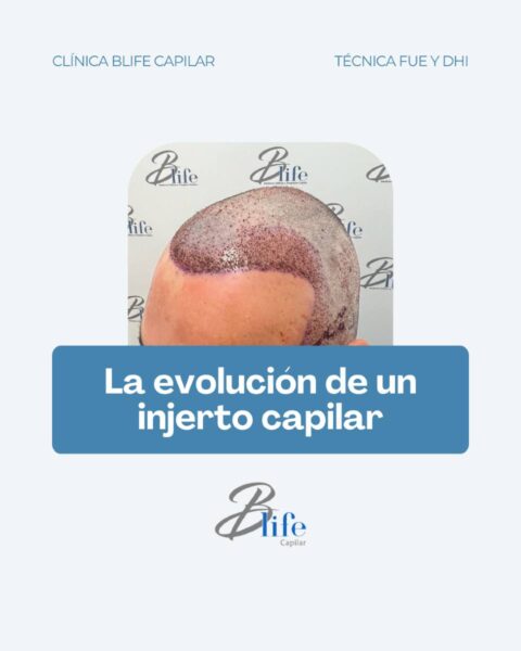 Cómo Saber si un Injerto Capilar ha Agarrado: Las 5 Fases Clave - Blife ...