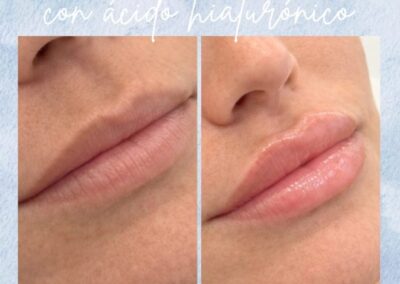 Antes y Despues Relleno de Labios Madrid 2