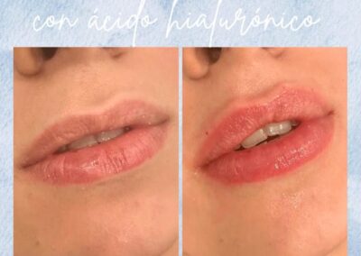 Antes y Despues Relleno de Labios Madrid 3