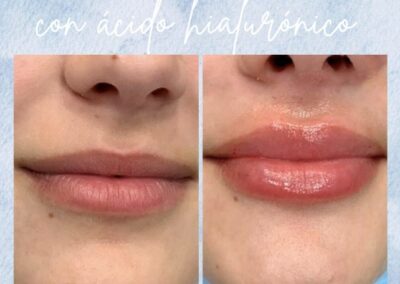 Antes y Despues Relleno de Labios Madrid 4