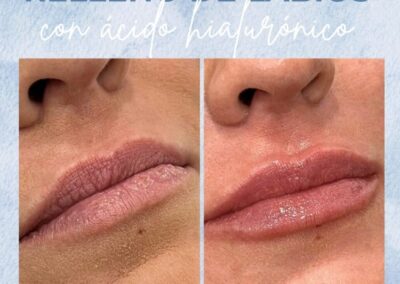 Antes y Despues Relleno de Labios Madrid 5