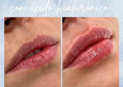 Antes y Despues Relleno de Labios Madrid 6