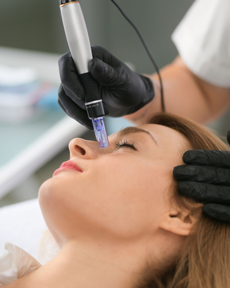 dermapen-en-madrid