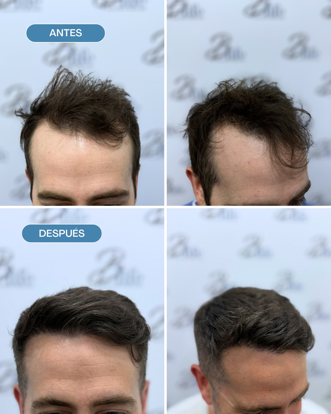 injerto capilar FUE antes y despues