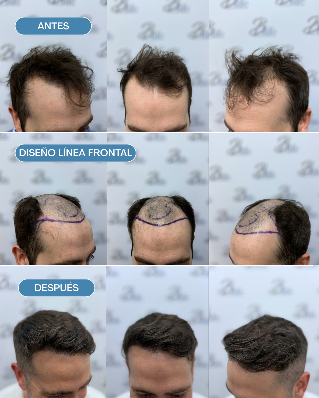 injerto capilar FUE antes y despues