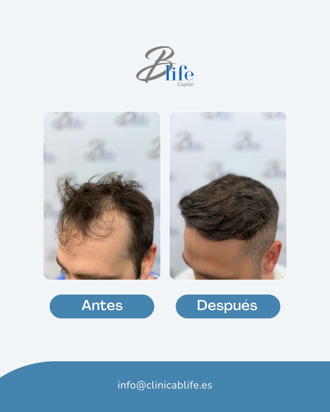 injerto capilar FUE antes y despues